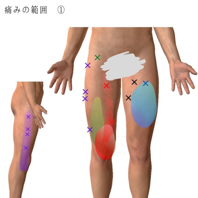 膝の痛みのトリガーポイントと原因となる筋肉③